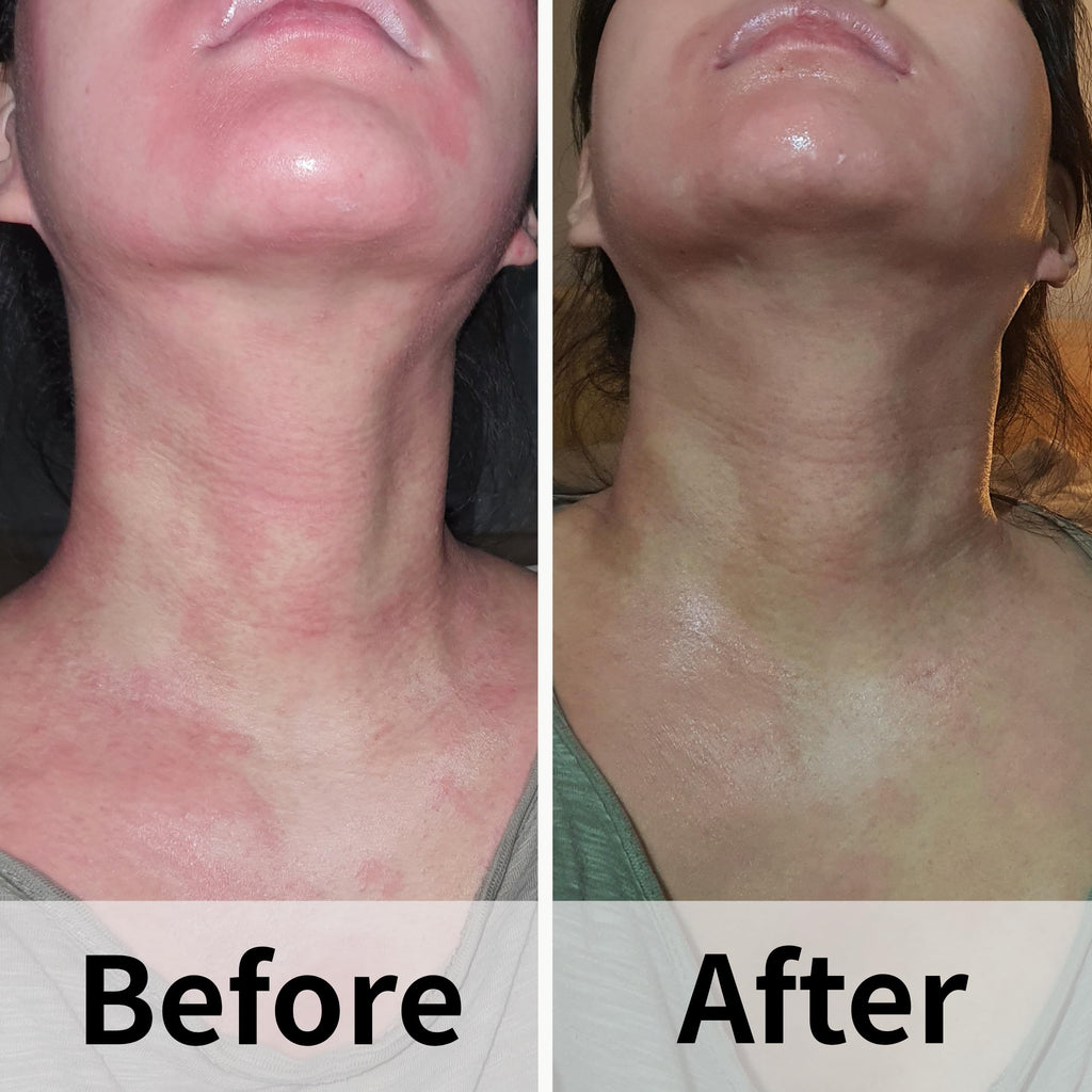 AD SOLUTION Ato Fast Calming Serum for Sensitive & Eczema-Prone Skin Instant Relief from Itch, Redness & Flare-Ups