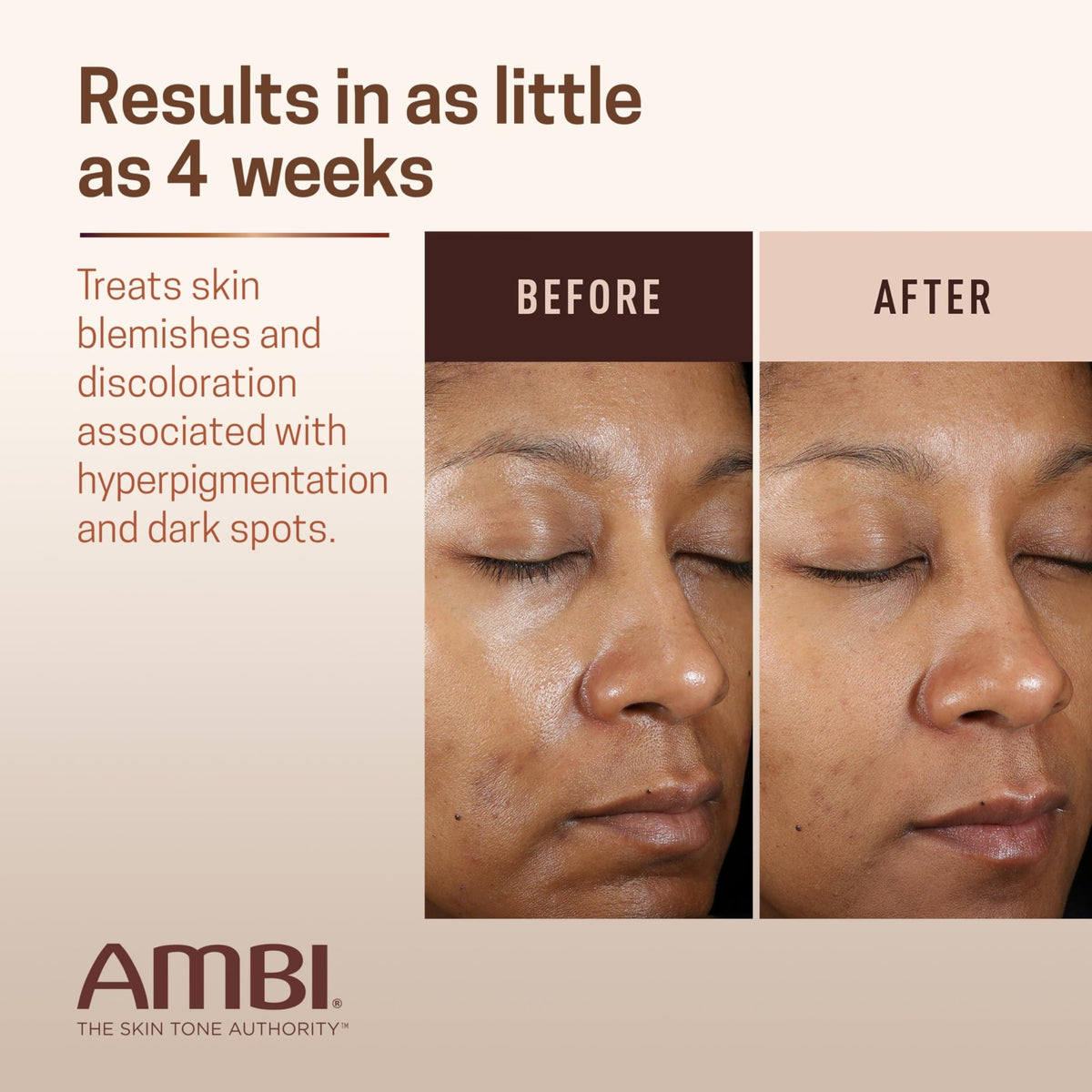 Ambi Even & Clear Advanced Fade Cream, Hydroquinone-free, Hyperpigmentation Treatment, Stubborn Dark Spot Corrector, Results In As Little As 2-3 Weeks - FENGGESTORE20