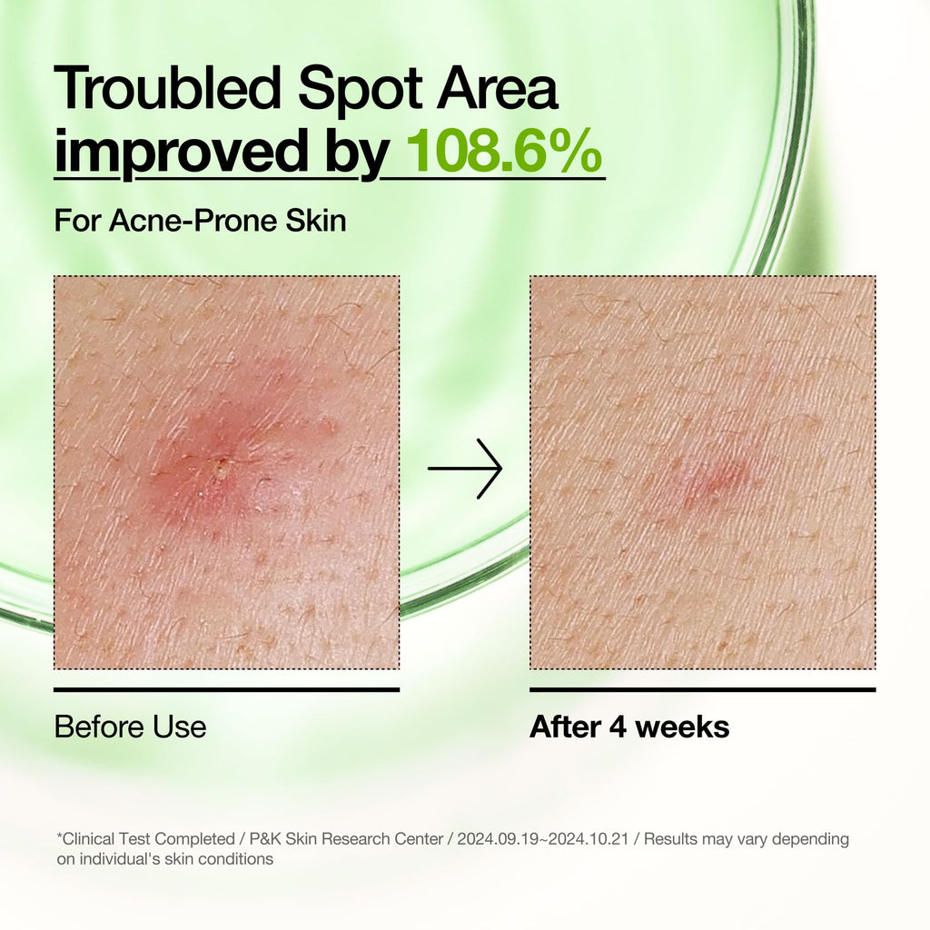 Anua Azelaic Acid 10 Hyaluron Redness Soothing Serum, Facial Serum for Blemish-Prone & Oily-Prone Skin - FENGGESTORE20
