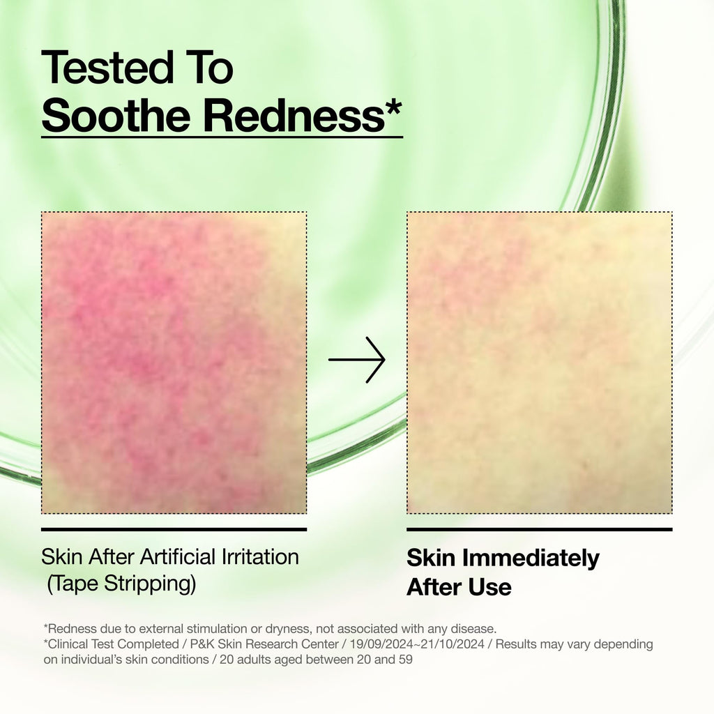 Anua Azelaic Acid 10 Hyaluron Redness Soothing Serum, Facial Serum for Blemish-Prone & Oily-Prone Skin - FENGGESTORE20
