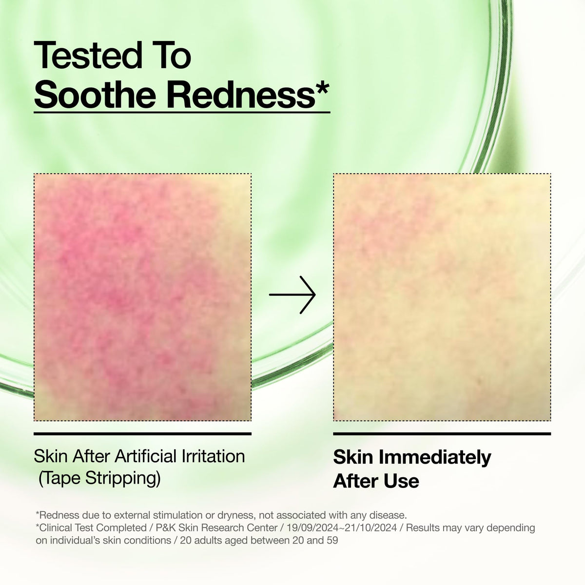 Anua Azelaic Acid 10 Hyaluron Redness Soothing Serum, Facial Serum for Blemish-Prone & Oily-Prone Skin - FENGGESTORE20