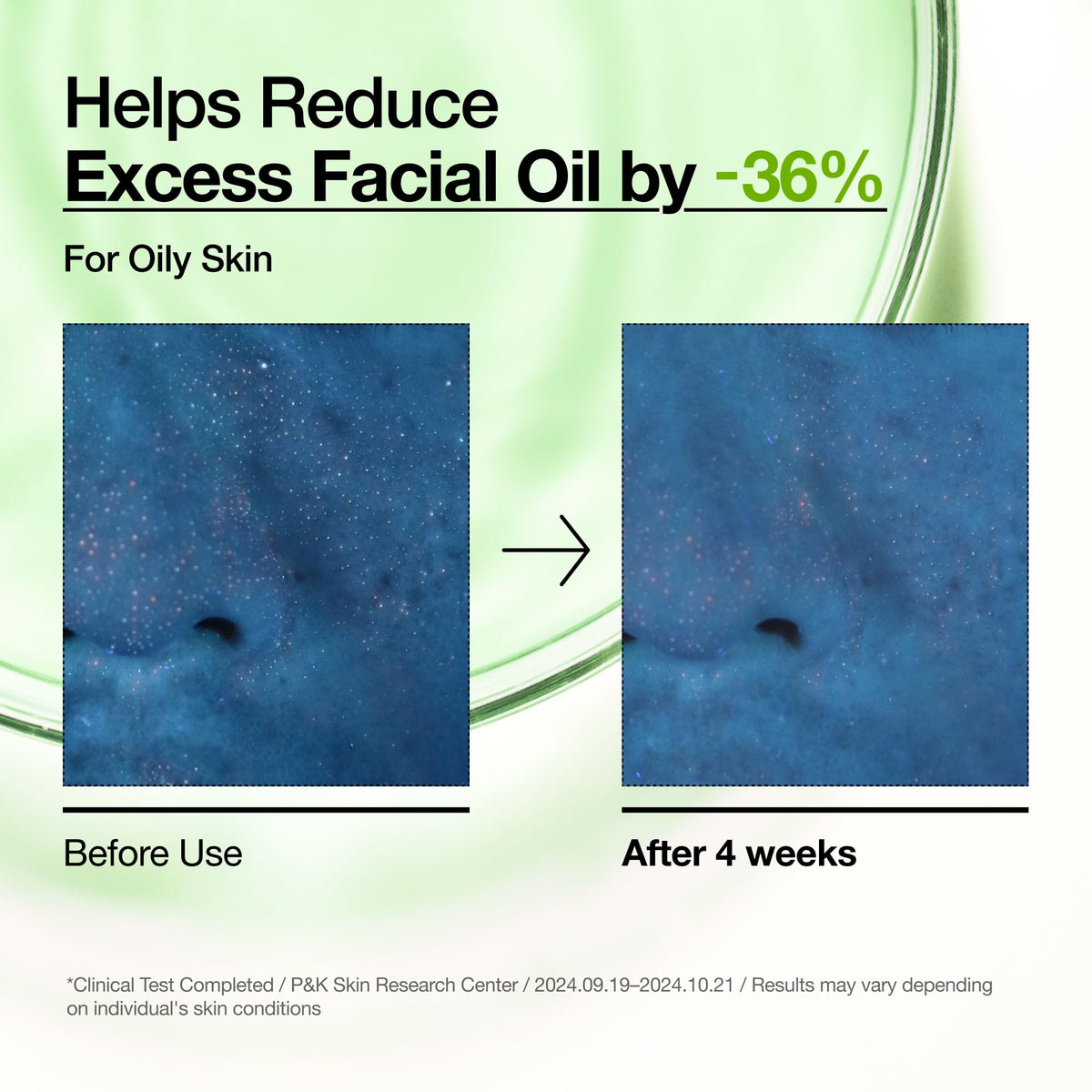 Anua Azelaic Acid 10 Hyaluron Redness Soothing Serum, Facial Serum for Blemish-Prone & Oily-Prone Skin - FENGGESTORE20