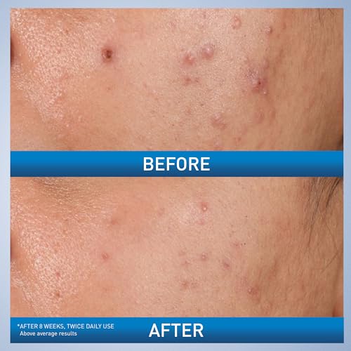 CeraVe Acne Control Gel, 2% Salicylic Acid Treatment With Glycolic Acid + Lactic Acids - FENGGESTORE20