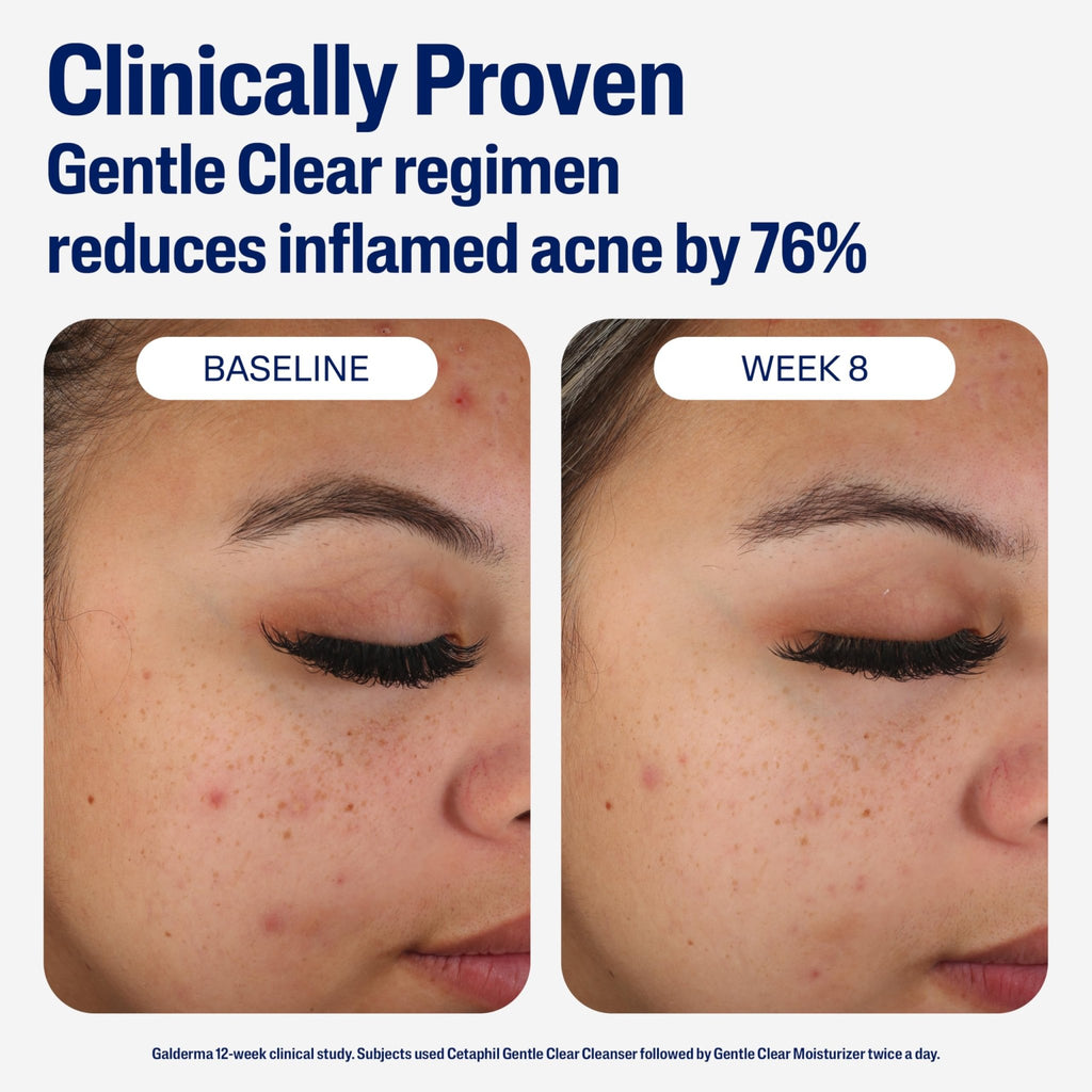 Cetaphil Face Moisturizer, Gentle Clear Mattifying Acne Moisturizer With 0.5% Salicylic Acid - FENGGESTORE20
