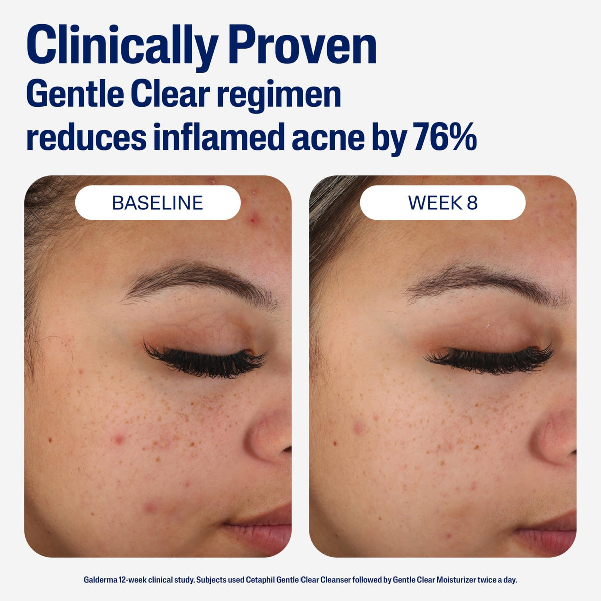 Cetaphil Face Moisturizer, Gentle Clear Mattifying Acne Moisturizer With 0.5% Salicylic Acid - FENGGESTORE20
