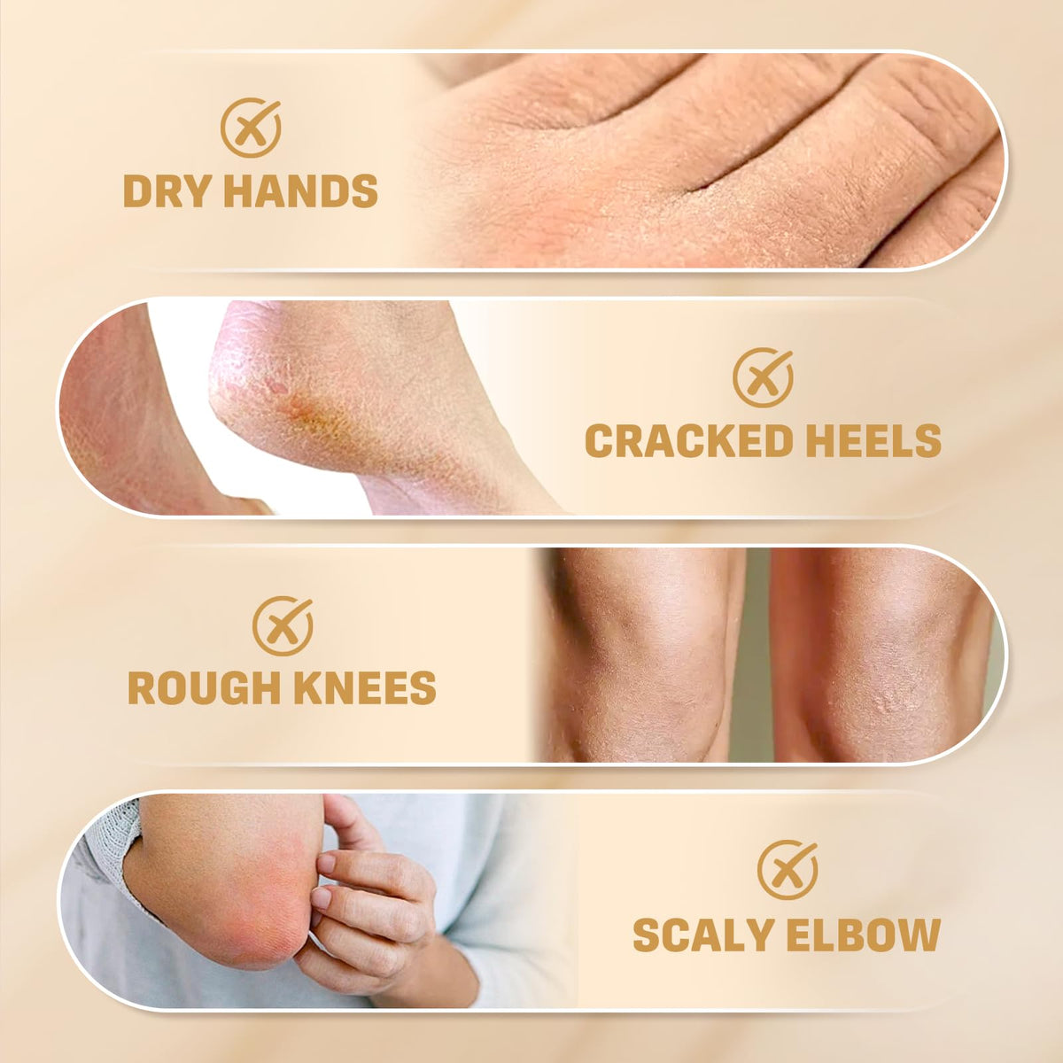 Clyecfra 60% Urea Cream with 2% Salicylic Acid, Urea Cream 60 Percent for Feet & Hands- Maximum Strength Moisturizer for Rough, Dry, Thick & Cracked Skin, Callus Remover, Deep Hydration, 150g - FENGGESTORE20