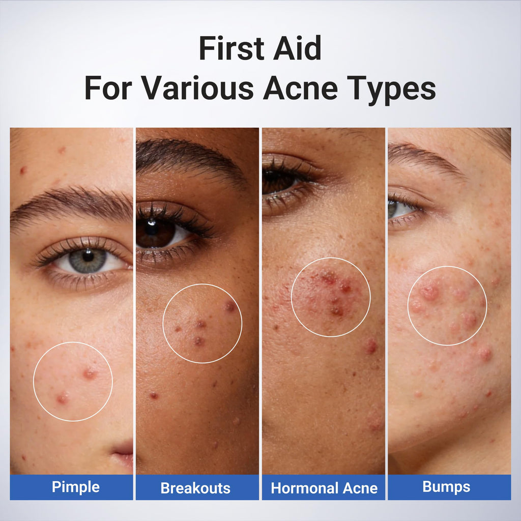 Dr.Leo 1.8% Salicylic Acid Spot Serum, Acne Treatment for Acne-Prone Sensitive Skin | Niacinamide, Fast Pimple Relief, Fades Acne Marks - FENGGESTORE20