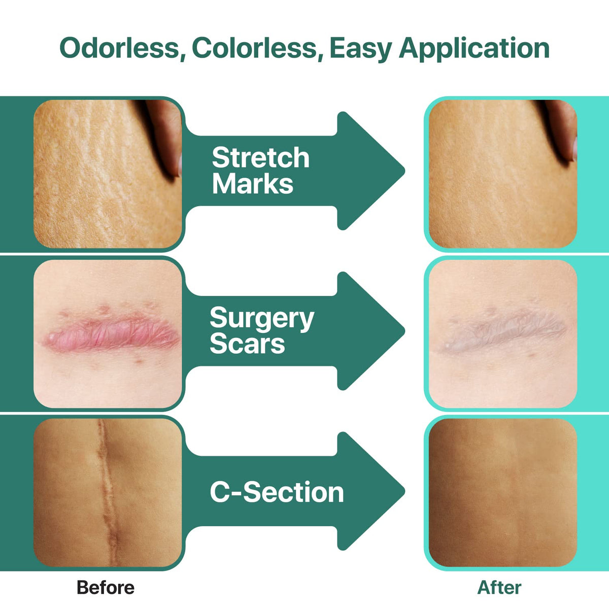 Ebanel Bundle of 30% AHA 2% BHA Chemical Peel and Advanced Silicone Scar Gel - FENGGESTORE20