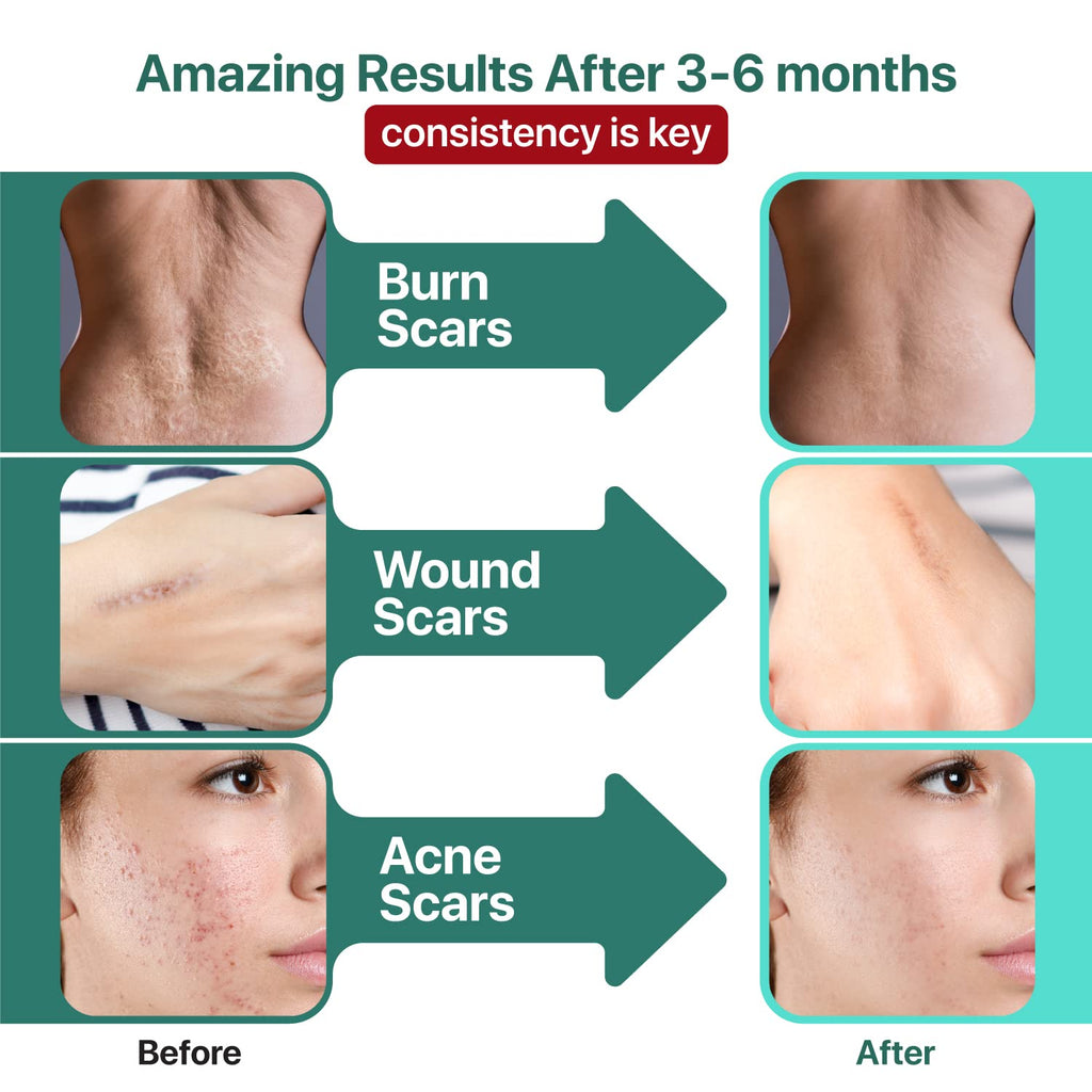 Ebanel Bundle of Advanced Silicone Scar Gel 1 Oz, and Hyaluronic Acid Serum - FENGGESTORE20