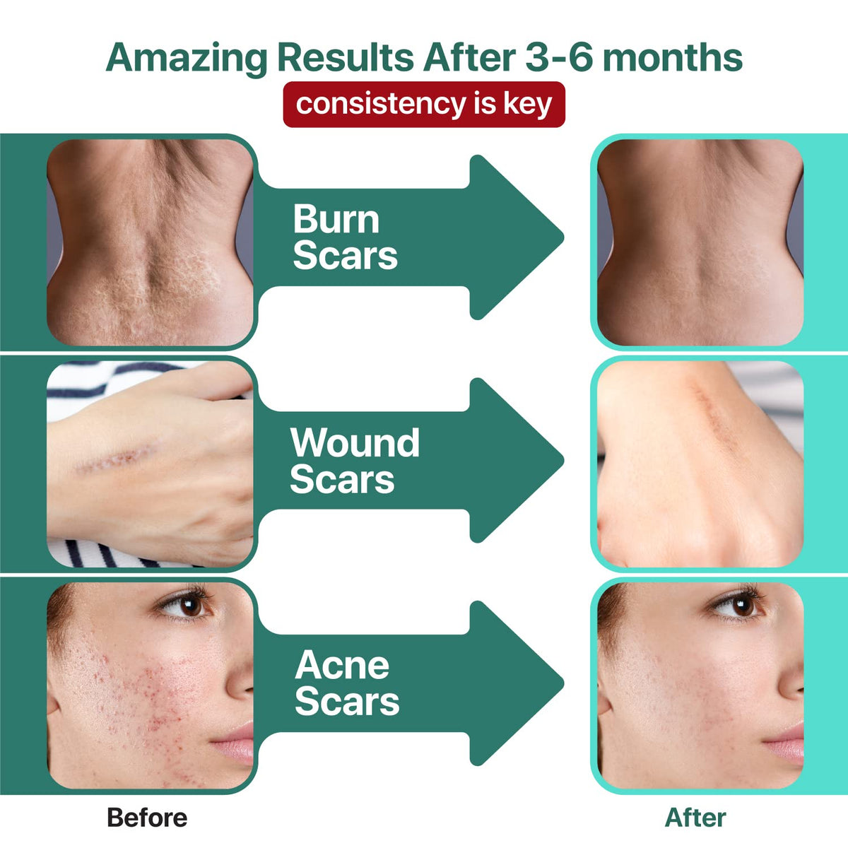 Ebanel Bundle of Lidocaine Numbing Cream, and Advanced Silicone Scar Gel 1 Oz - FENGGESTORE20