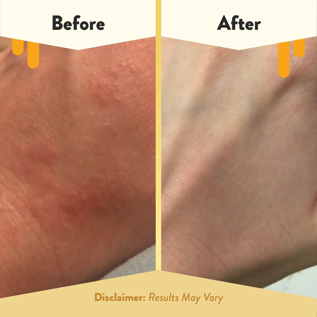 ECZEMA HONEY Oatmeal Body Lotion - Hand & Body Cream for Eczema Relief - Natural Dry Skin Repair (16 Oz) - FENGGESTORE20
