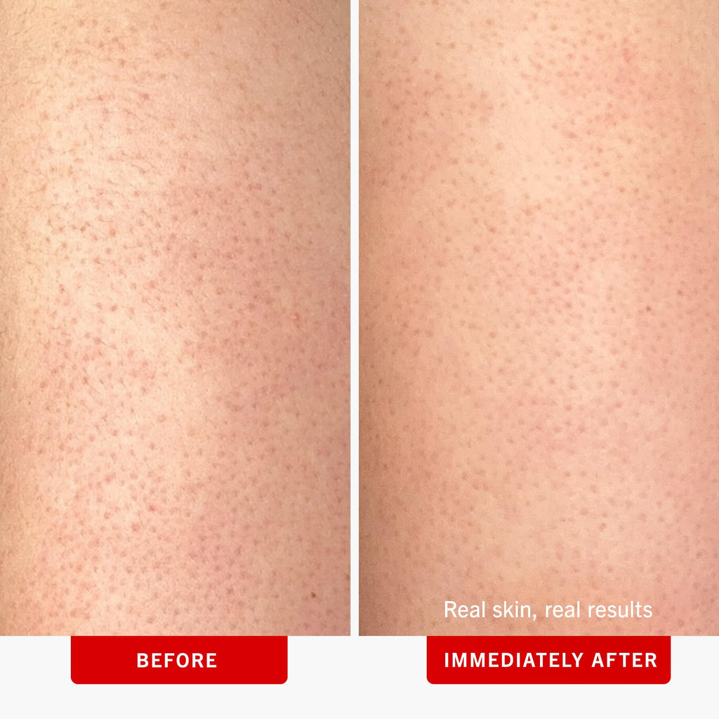 First Aid Beauty - KP Bump Eraser Body Scrub with 10% AHA, Keratosis Pilaris Exfoliator with Glycolic and Lactic acids, Helps Reduce Chicken Skin Bumps - FENGGESTORE20