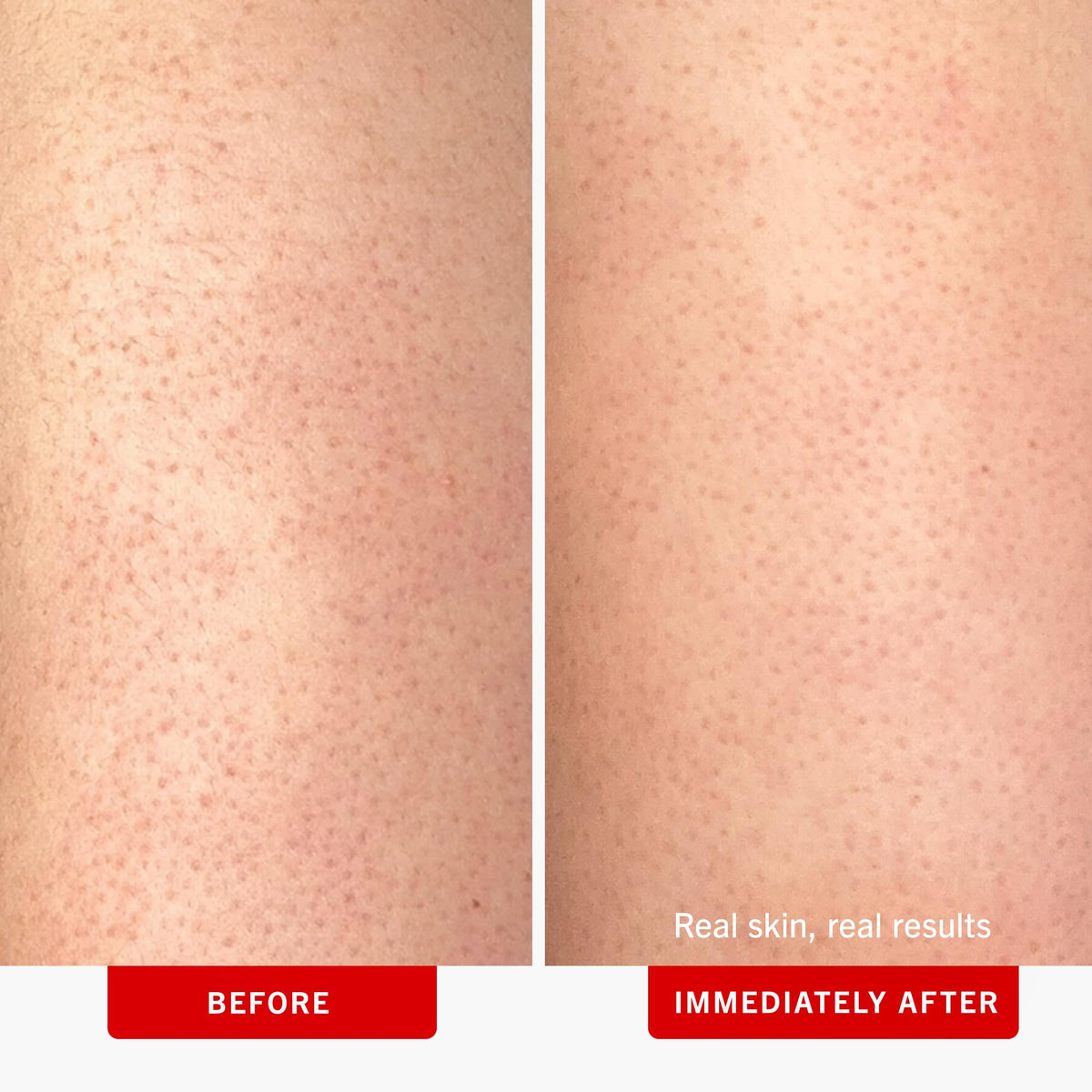 First Aid Beauty - KP Bump Eraser Body Scrub with 10% AHA, Keratosis Pilaris Exfoliator with Glycolic and Lactic acids, Helps Reduce Chicken Skin Bumps - FENGGESTORE20