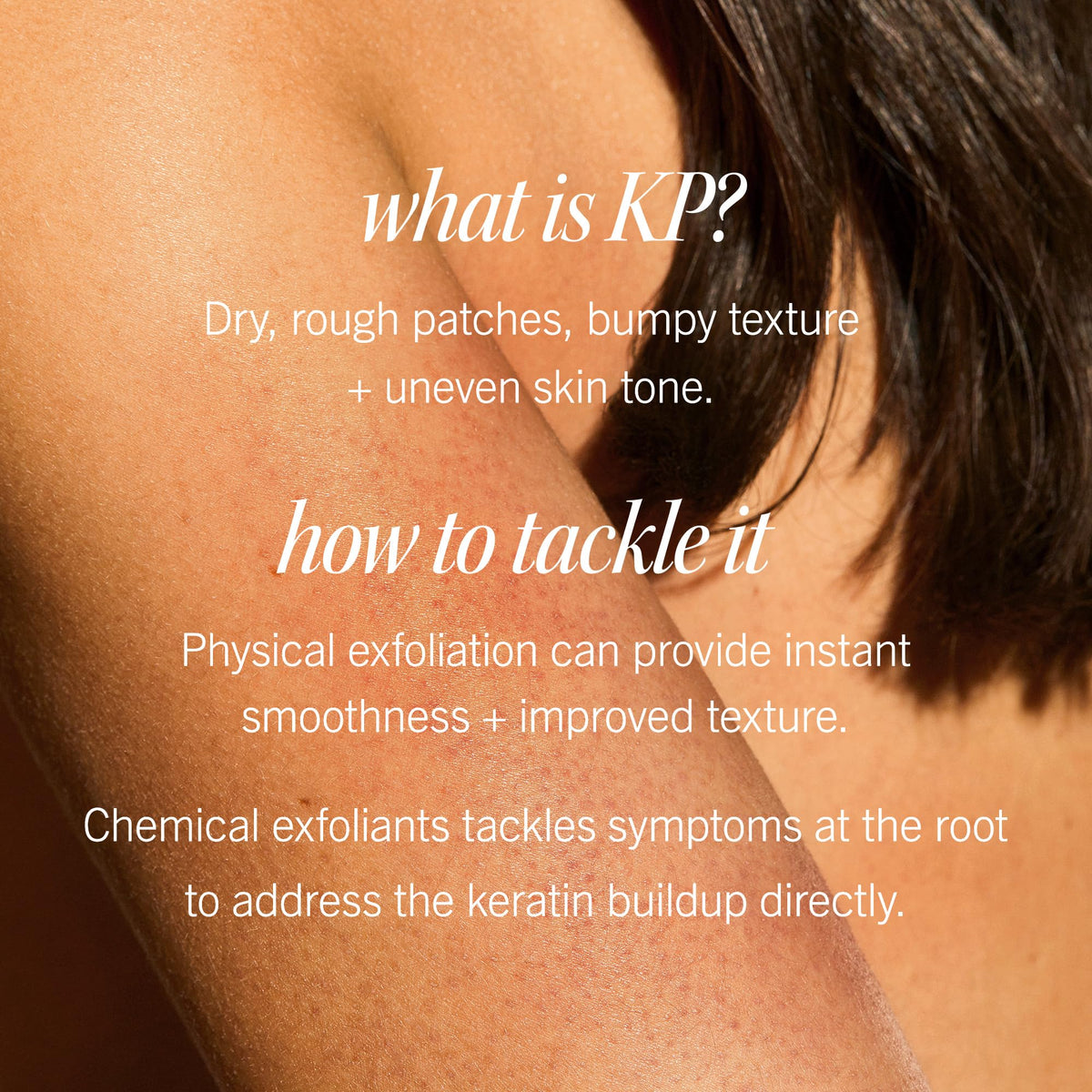 First Aid Beauty - KP Bump Eraser Body Scrub with 10% AHA, Keratosis Pilaris Exfoliator with Glycolic and Lactic acids, Helps Reduce Chicken Skin Bumps - FENGGESTORE20