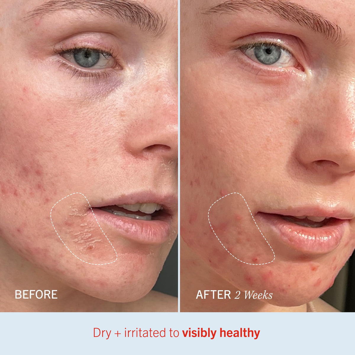 First Aid Beauty - Ultra Repair Cream, Intense Hydration Whipped Colloidal Oatmeal, Clinically Proven to Strengthen Skin Barrier in 7 Days - FENGGESTORE20