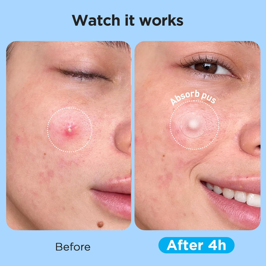 Glowpatch Pimple Patches for Face (504 Count), FSA Eligible Acne Patch Bulk, Zit Stickers 4 Sizes, Hydrocolloid Spot Stickers - FENGGESTORE20