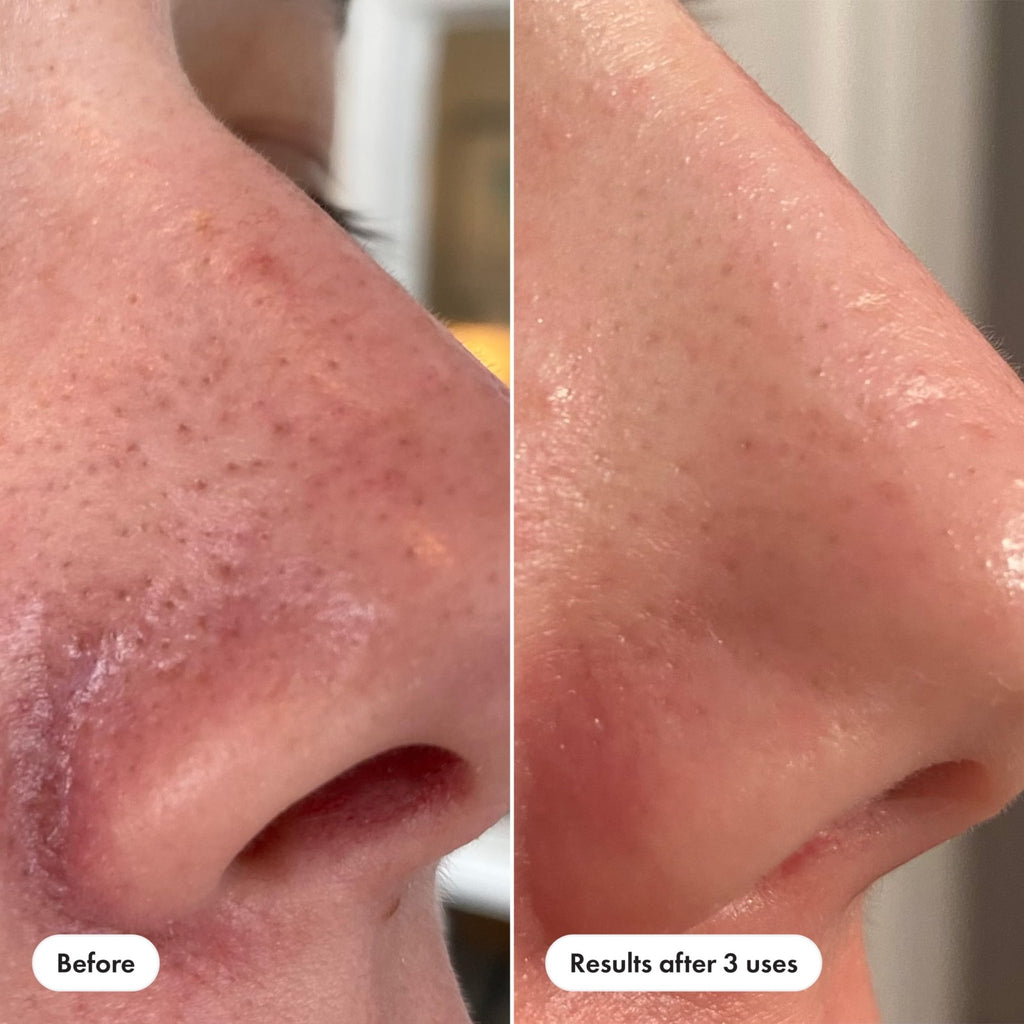 Hero Cosmetics Pore Release Blackhead Clearing Solution, Exfoliating 2% Salicylic Acid Toner Featuring AHA, BHA, and PHA - FENGGESTORE20
