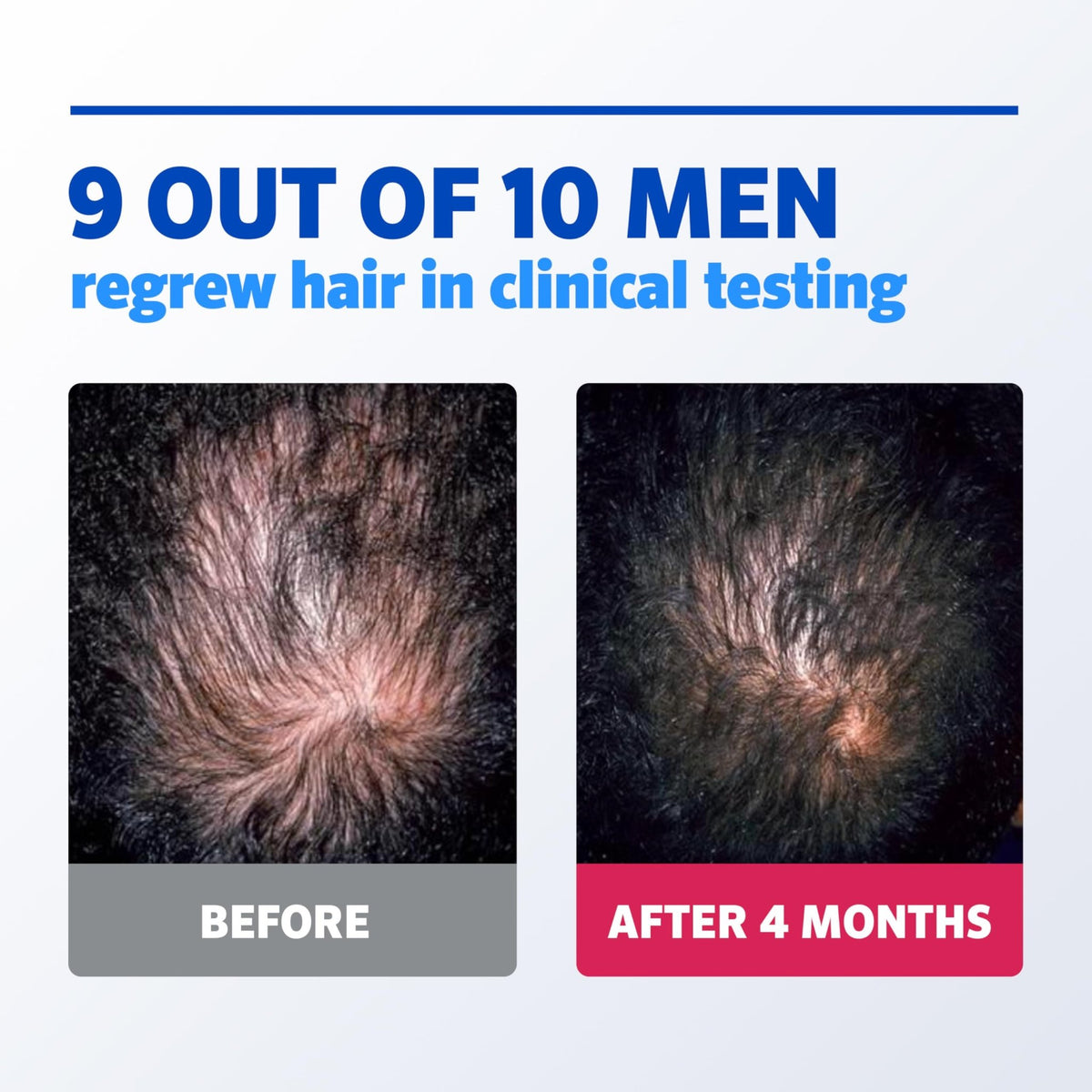 Men’s Rogaine 5% Minoxidil for Men Foam, Clinically Proven Regrowth for Thinning Hair, Topical Hair Loss Treatment, Unscented Topical Aerosol, Results in 8–16 Weeks - FENGGESTORE20