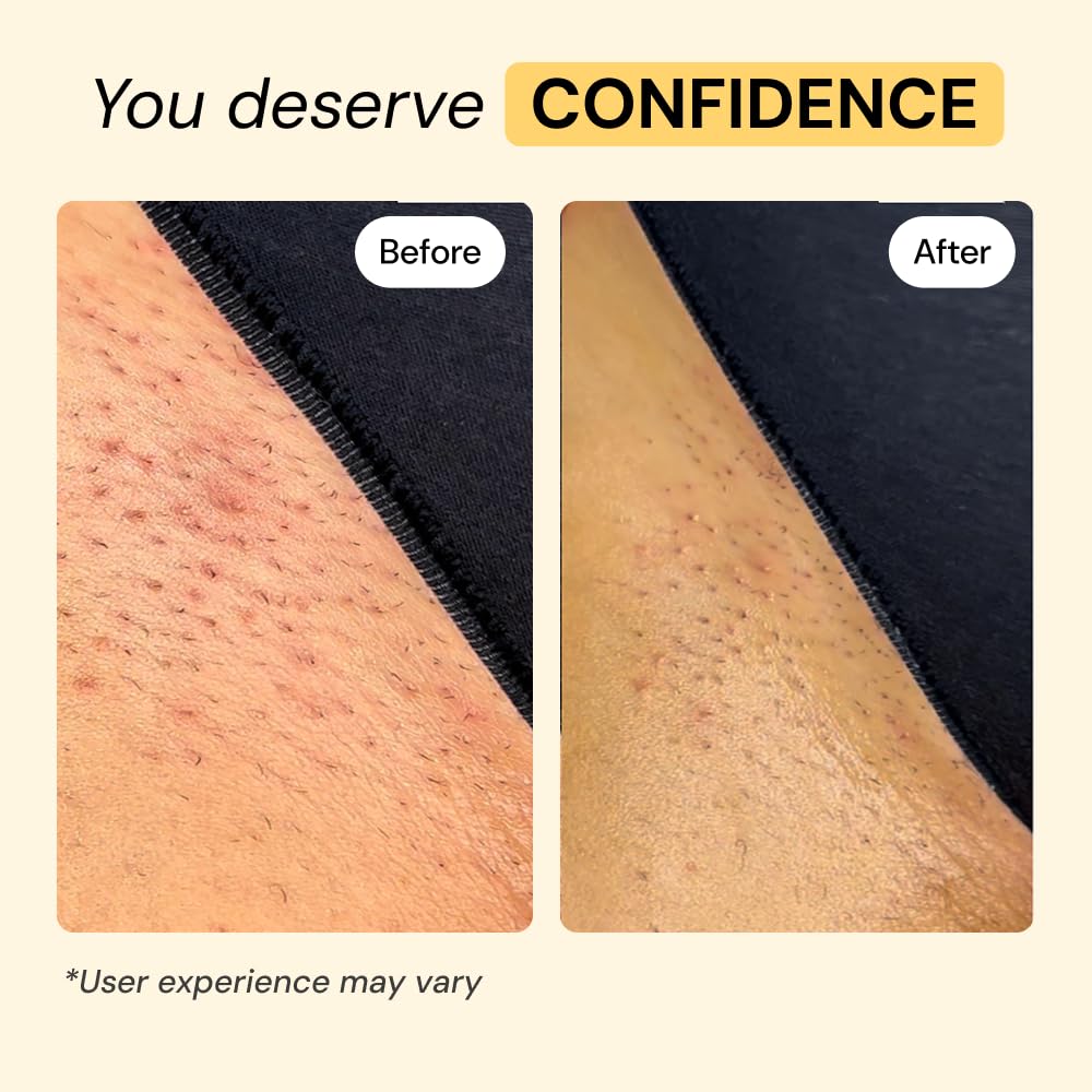 MyMagicHealer Thyme & Tea Tree Flare Care | Cystic Acne, Folliculitis, Ingrown Hair, Keratosis Pilaris, Razor Bumps, Body Bumps, Blind Pimples Multi-purpose Solution - FENGGESTORE20