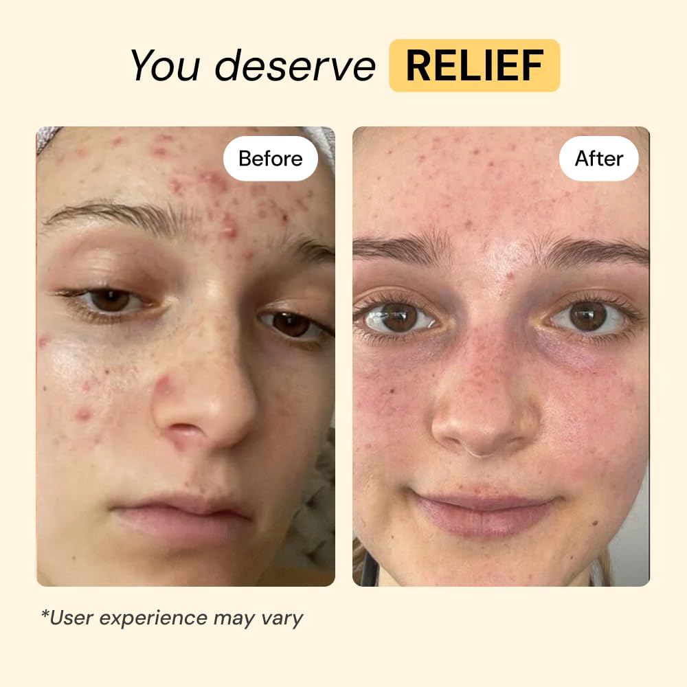 MyMagicHealer Thyme & Tea Tree Flare Care | Cystic Acne, Folliculitis, Ingrown Hair, Keratosis Pilaris, Razor Bumps, Body Bumps, Blind Pimples Multi-purpose Solution - FENGGESTORE20