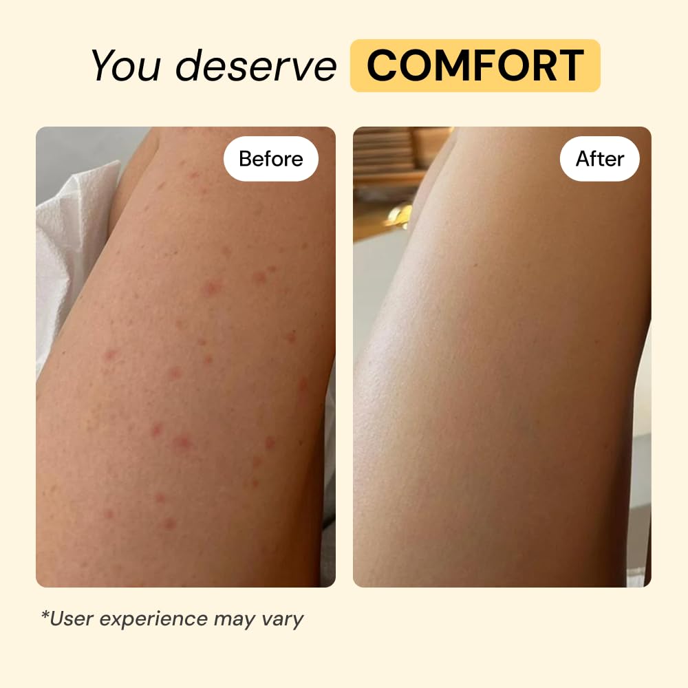 MyMagicHealer Thyme & Tea Tree Flare Care | Cystic Acne, Folliculitis, Ingrown Hair, Keratosis Pilaris, Razor Bumps, Body Bumps, Blind Pimples Multi-purpose Solution - FENGGESTORE20