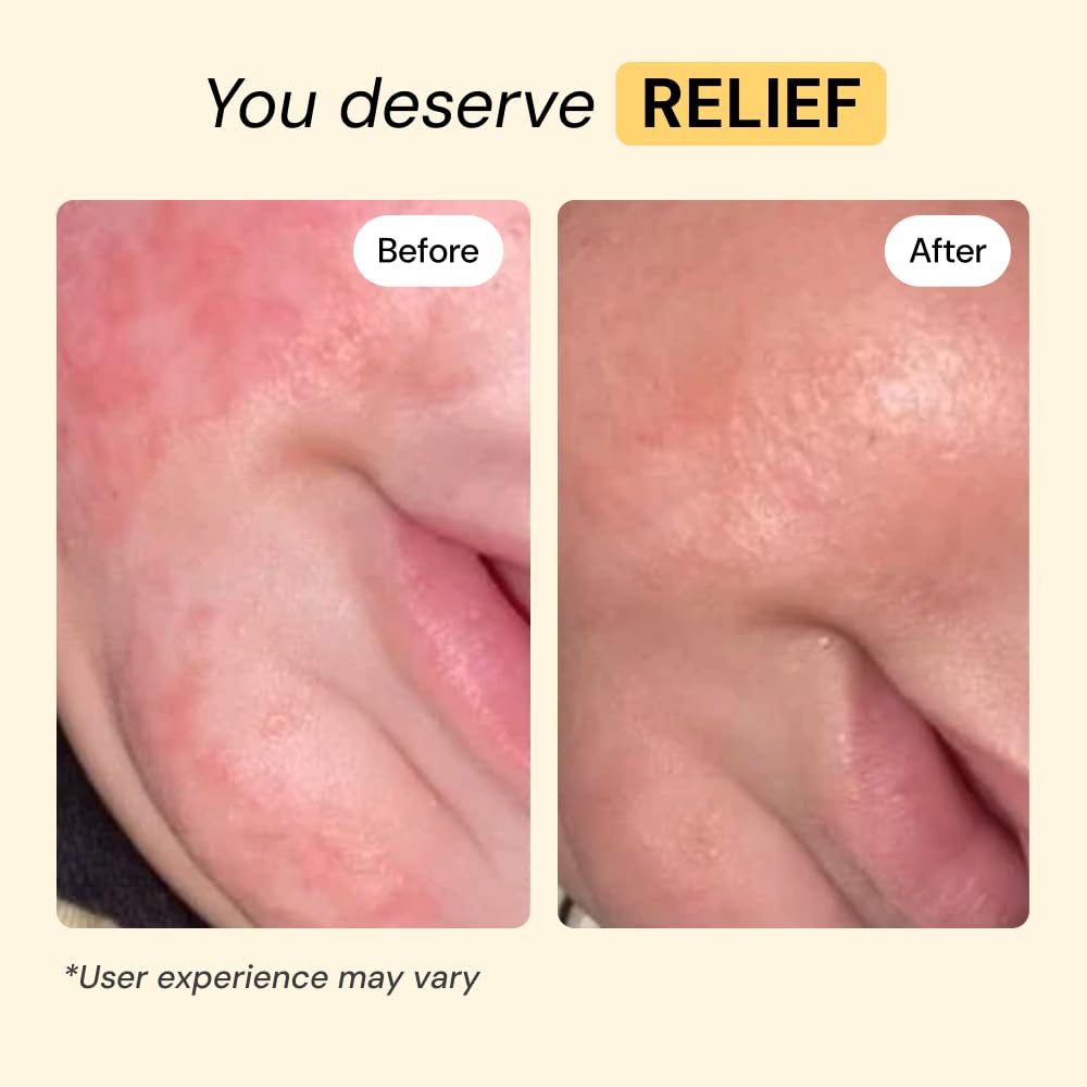MyMagicHealer Universal Flare Care | Essential Oil Free | Baby Dermatitis, Diaper Rash, Eczema, Psoriasis, Impetigo | Wound Car - FENGGESTORE20