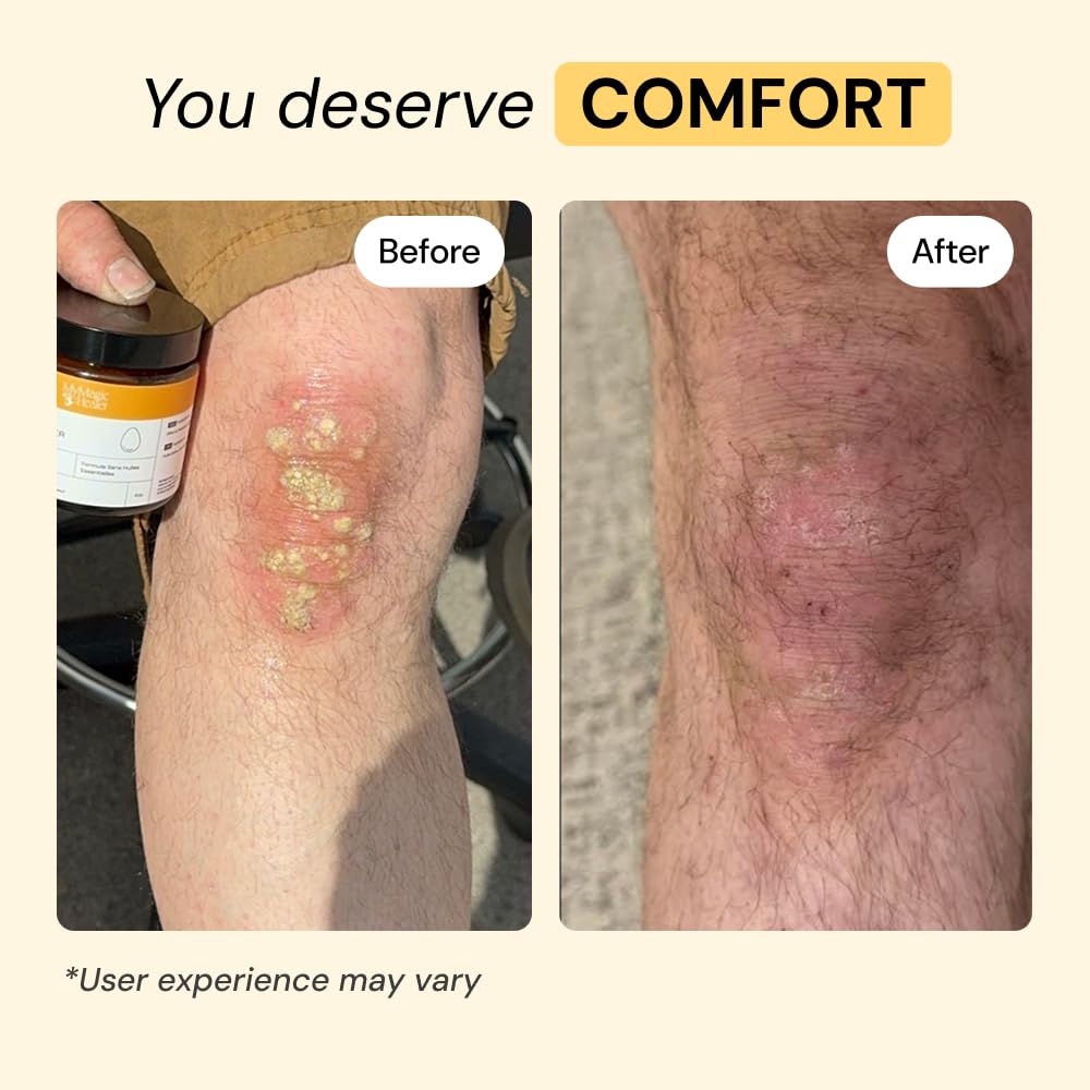 MyMagicHealer Universal Flare Care | Essential Oil Free | Baby Dermatitis, Diaper Rash, Eczema, Psoriasis, Impetigo | Wound Car - FENGGESTORE20