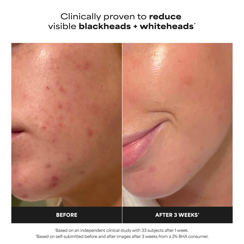 Paulas Choice - SKIN PERFECTING 2% BHA Liquid Salicylic Acid Exfoliant - Facial Exfoliant - FENGGESTORE20