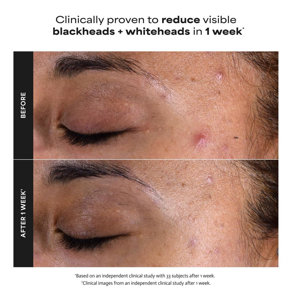 Paulas Choice - SKIN PERFECTING 2% BHA Liquid Salicylic Acid Exfoliant - Facial Exfoliant - FENGGESTORE20