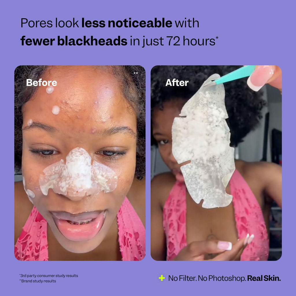 Peach Slices - Nose Pore Patches (7 ct) - Overnight Blackhead Remover - Pore Strips - Absorbs Gunk - Thin, Flexible & Painless - Hydrocolloid Patches - FENGGESTORE20