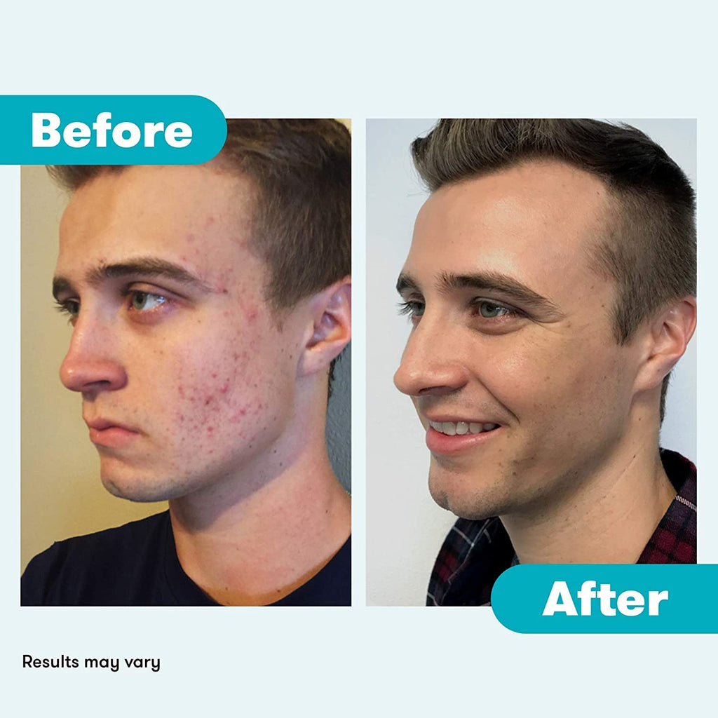 Proactiv Acne Cleanser - Benzoyl Peroxide Face Wash and Acne Treatment - Daily Facial Cleanser and Hyularonic Acid - FENGGESTORE20