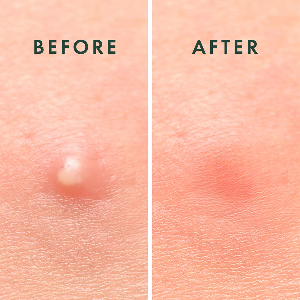 Rael Pimple Patches, Miracle Invisible Spot Cover - Hydrocolloid Acne Pimple Patch - FENGGESTORE20