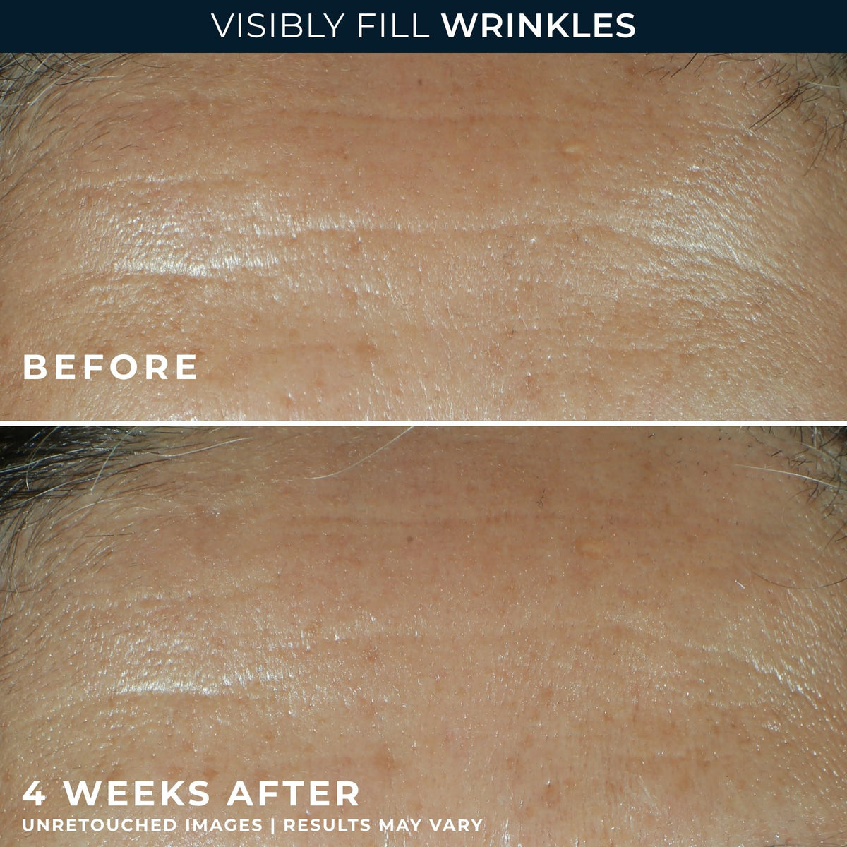 RoC Retinol Correxion Wrinkle Filler for Deep Wrinkles with Hyaluronic Acid & Retinol, Skin Care for Women and Men, - FENGGESTORE20