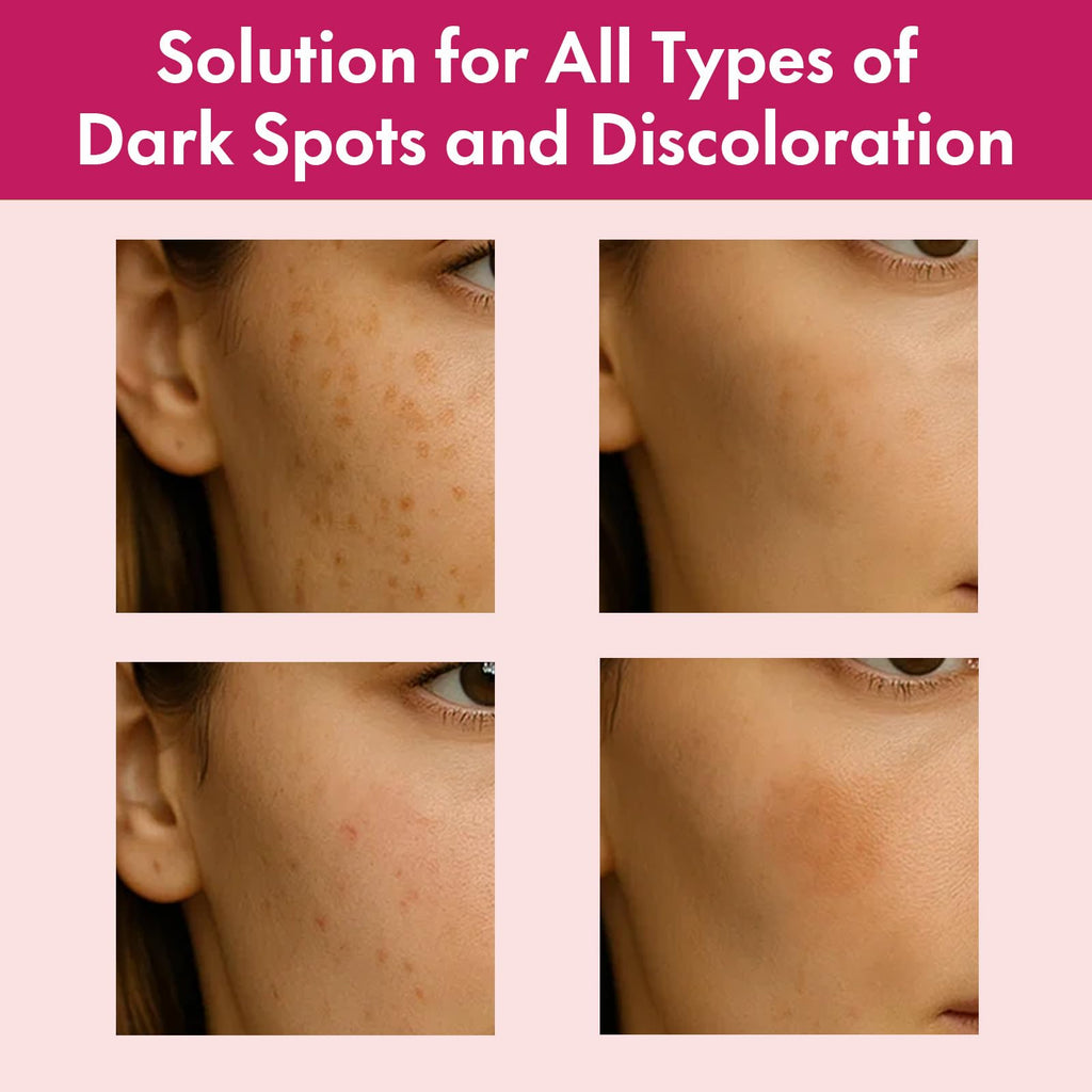 Roseblem Arbutin 7% + Tranexamic Acid 4% Face Cream for Dark Spots & Uneven Skin Tone - FENGGESTORE20