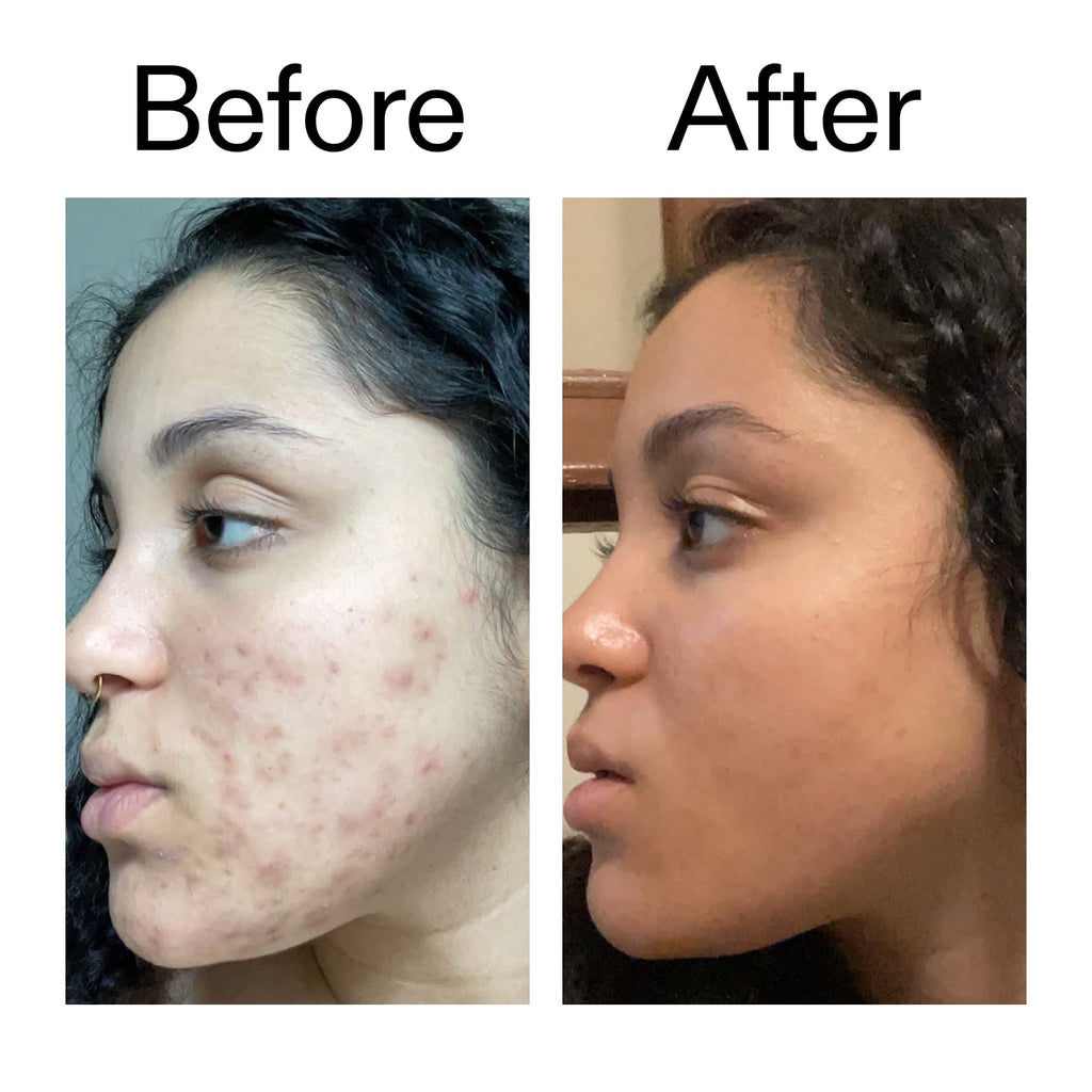 The INKEY List Tranexamic Acid Serum, Helps Reduce Appearance of Skin Discoloration - FENGGESTORE20
