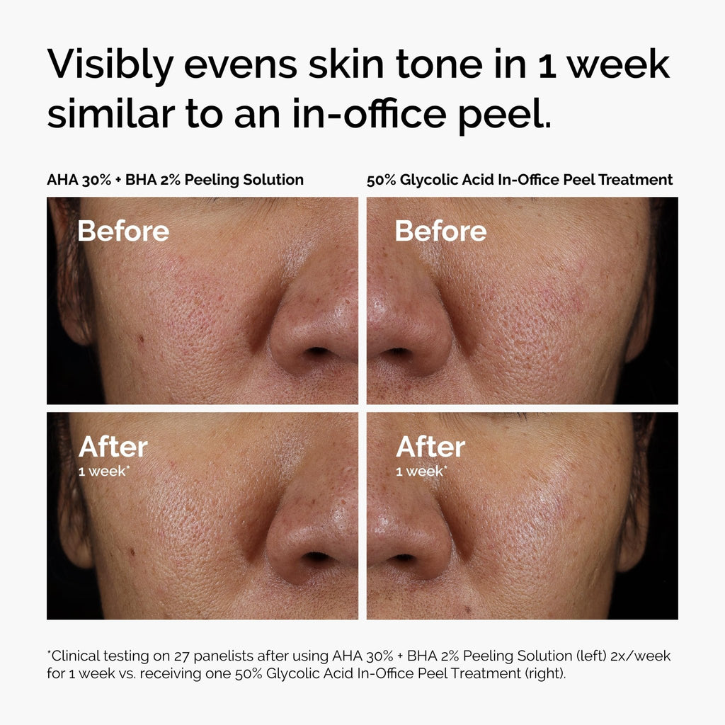 The Ordinary AHA 30% + BHA 2% Peeling Solution, Advanced Exfoliating Peel for Brighter Skin, 1 Fl Oz - FENGGESTORE20