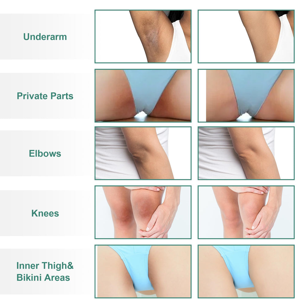 Vcetree Skin Bleaching Cream Skin Lightening for Body Intimate Areas, Private Parts, Underarm, Knees, Elbows, Inner Thigh, Bikini Area - FENGGESTORE20