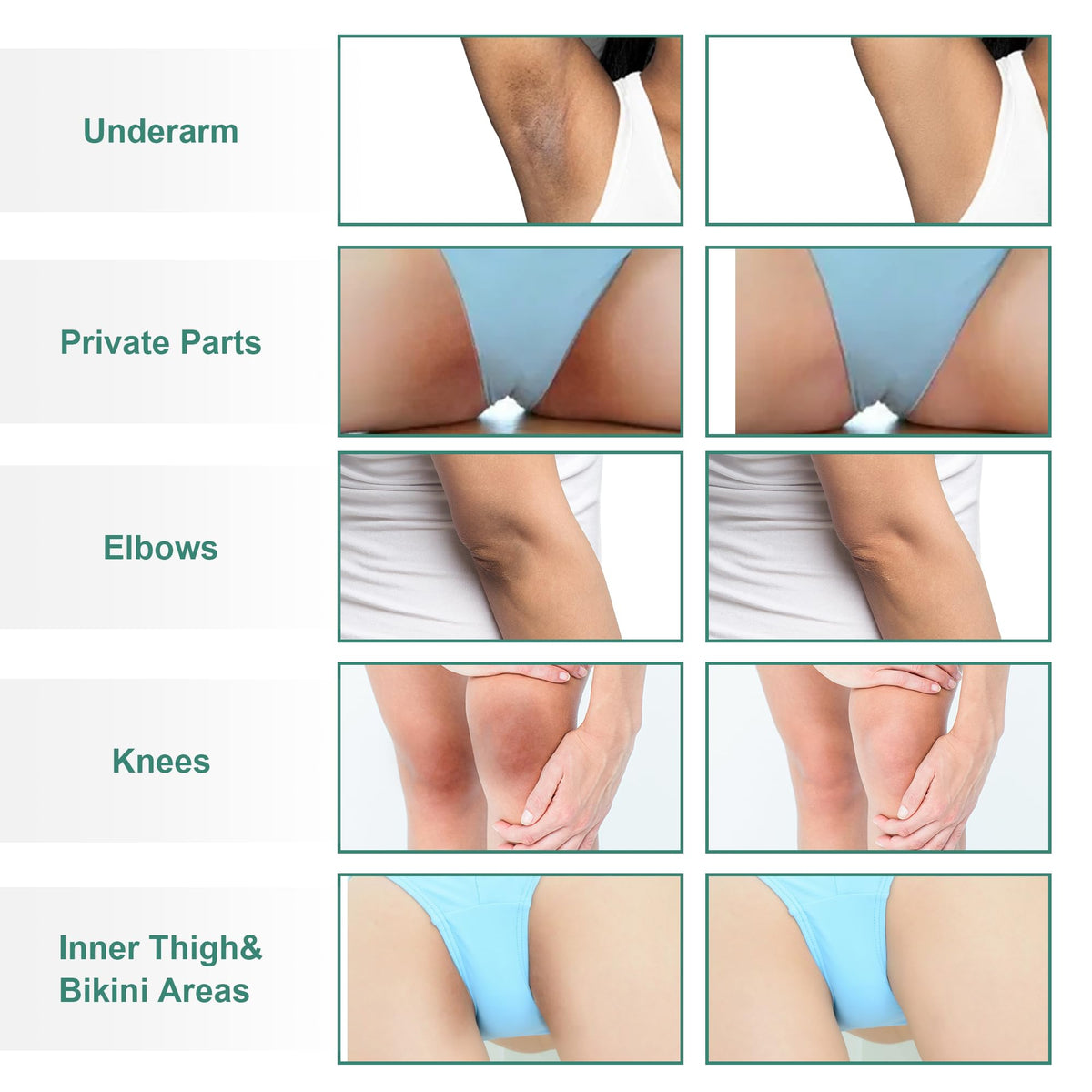 Vcetree Skin Bleaching Cream Skin Lightening for Body Intimate Areas, Private Parts, Underarm, Knees, Elbows, Inner Thigh, Bikini Area - FENGGESTORE20